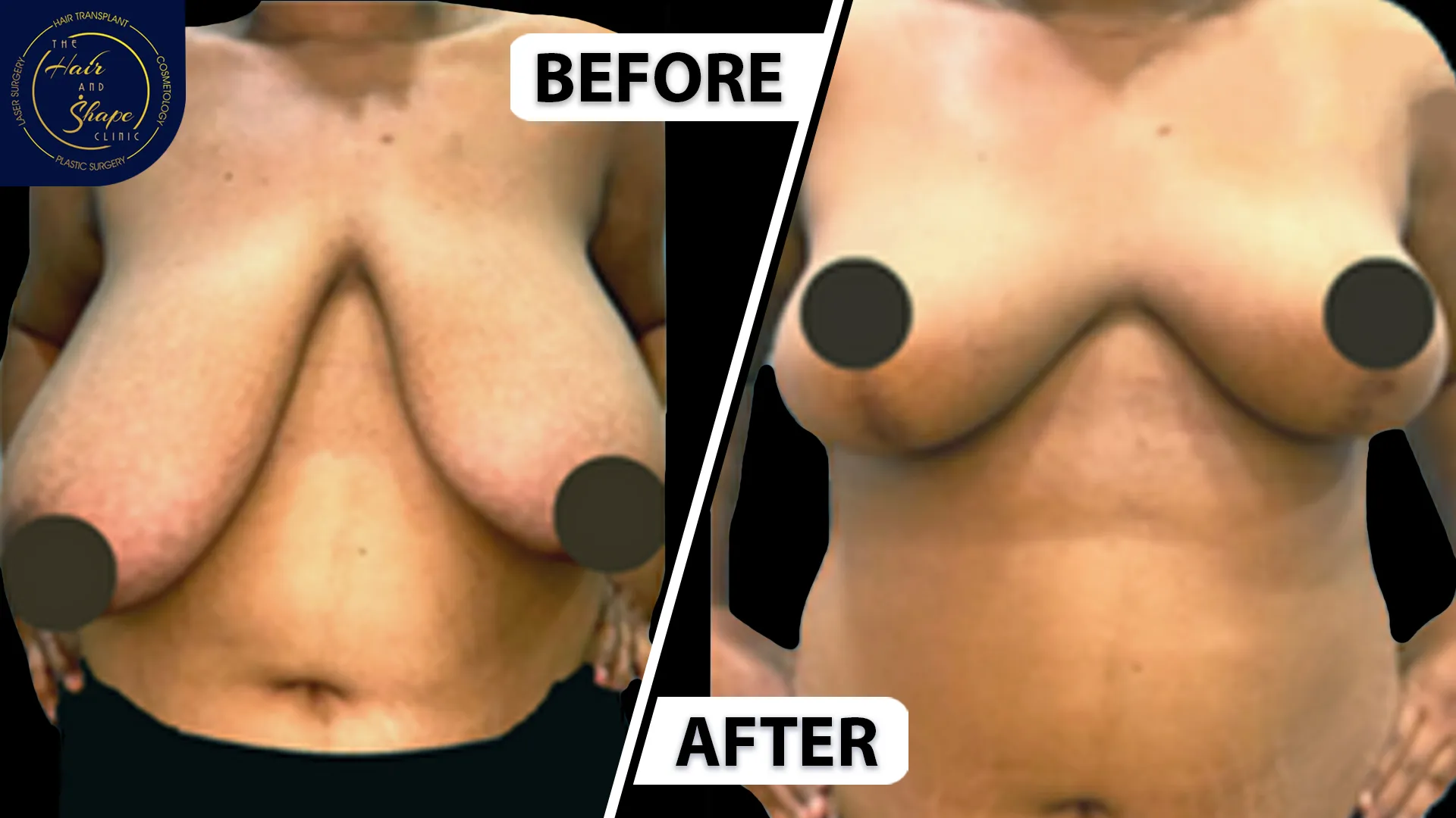 Breast Reduction result2